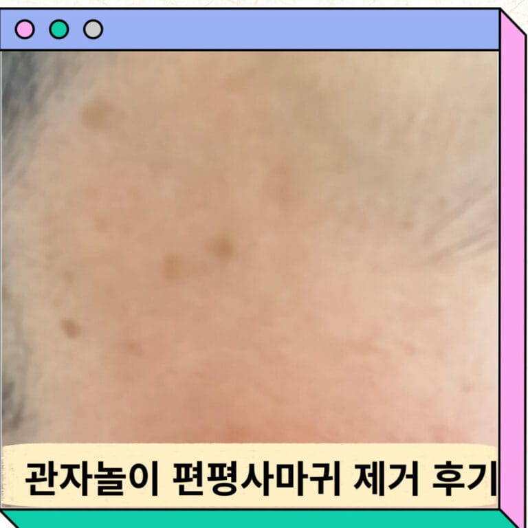 얼굴에 난 편평사마귀 레이저 제거 후기 가격
