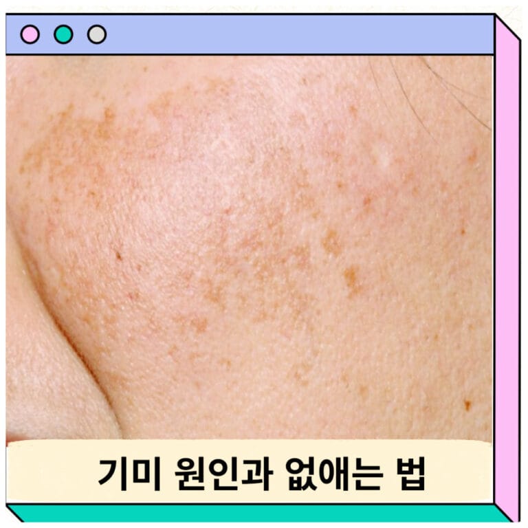 기미 없애는법 크림 패치 효과 제거 레이저 원인(0)