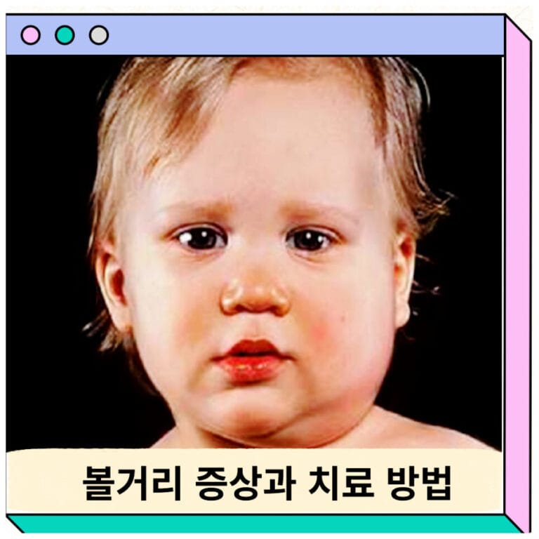 볼거리증상 치료 전염 원인 이하선염 병원 한번걸리면